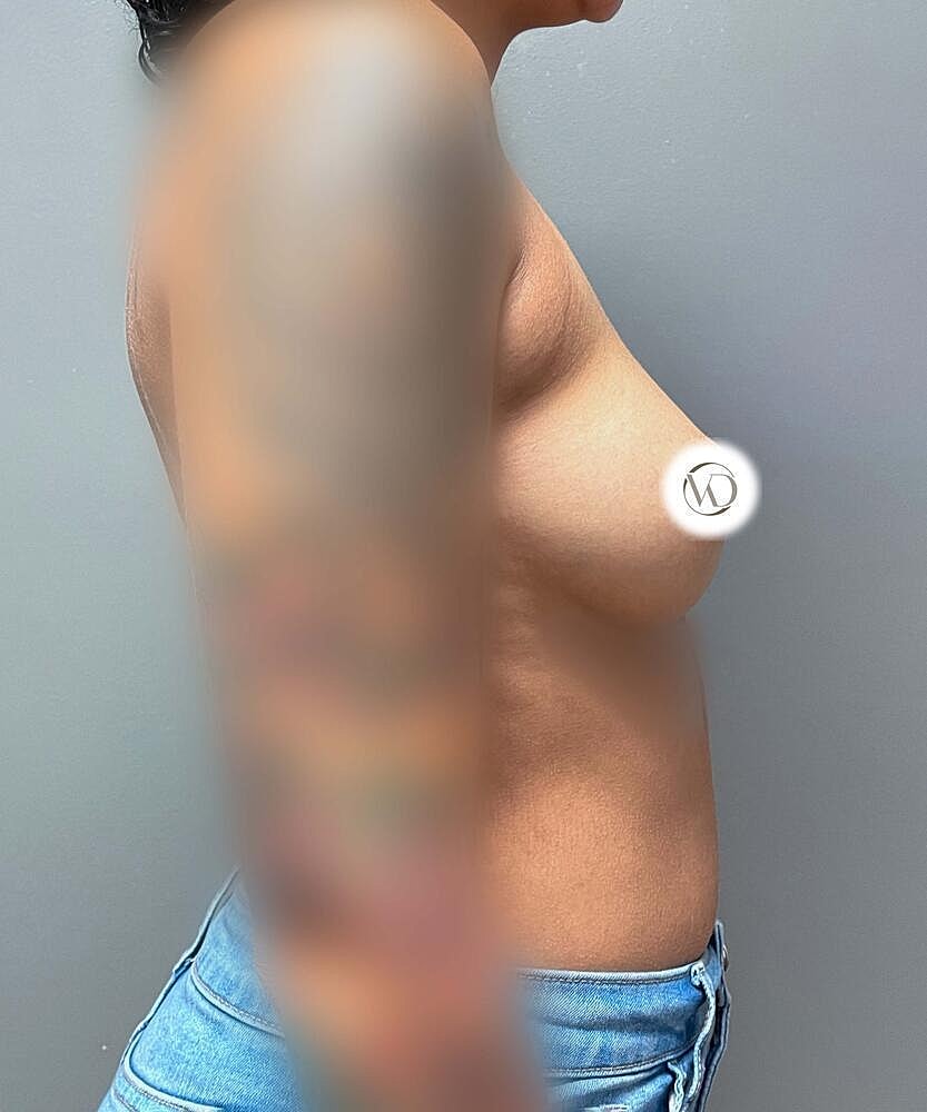 Breast Augmentation Before & After