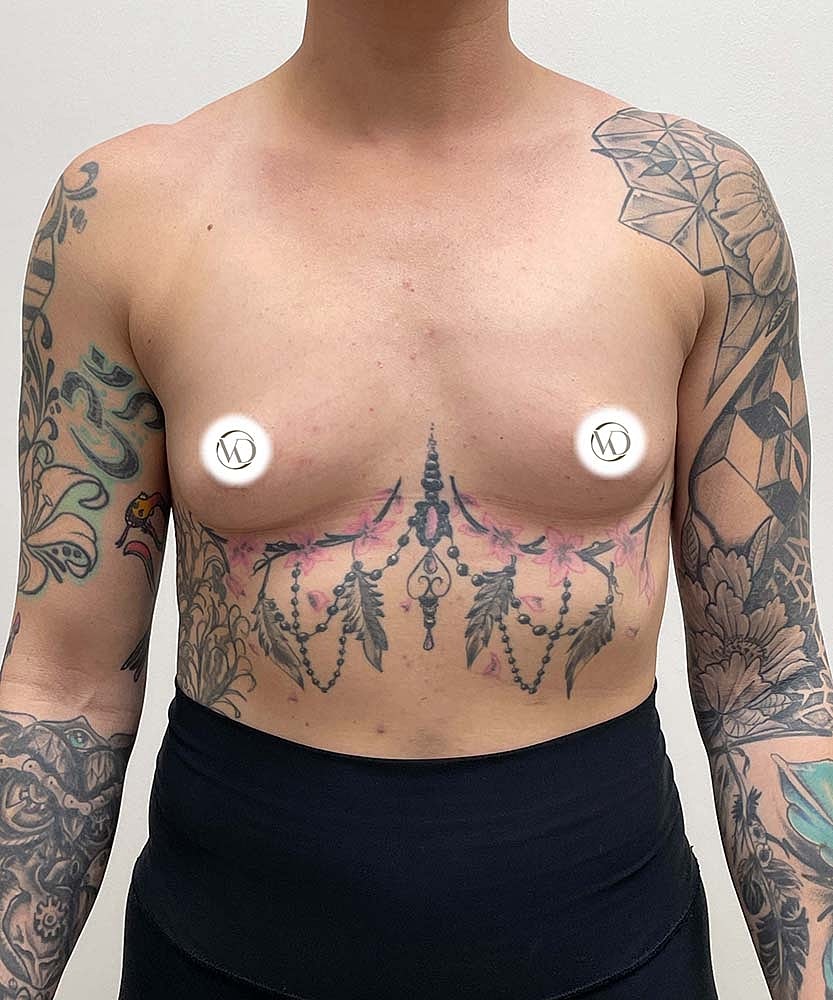Breast Augmentation Before & After