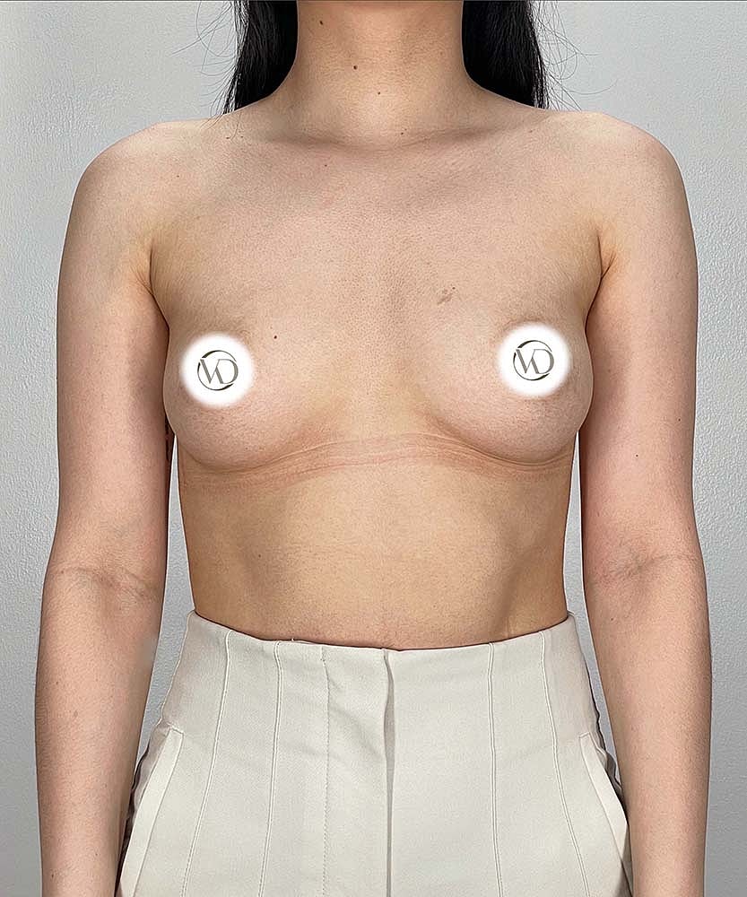 Breast Augmentation Before & After