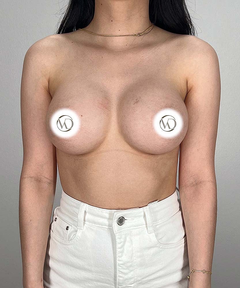 Breast Augmentation Before & After