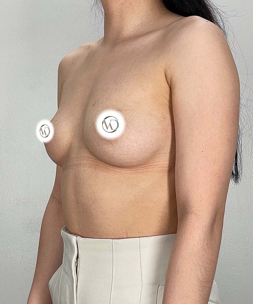 Breast Augmentation Before & After