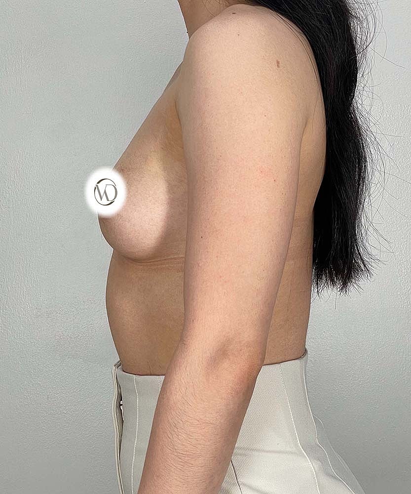 Breast Augmentation Before & After