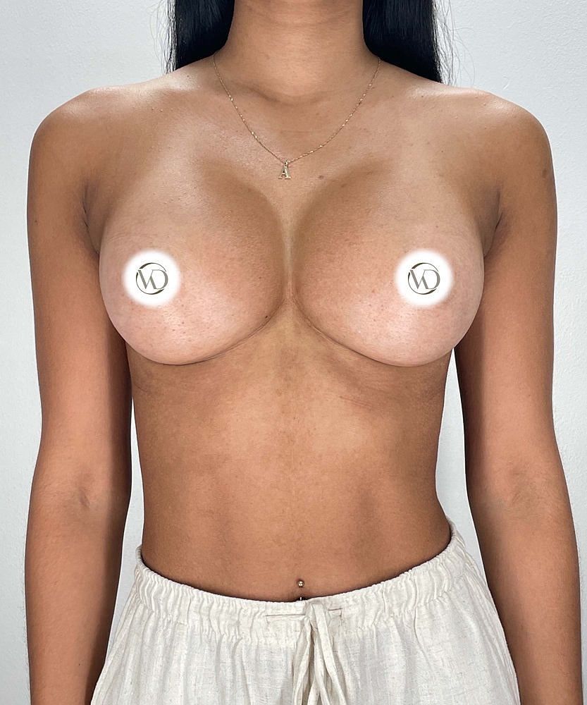 Breast Augmentation Before & After