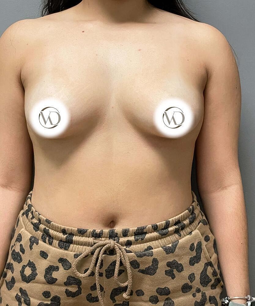 Breast Augmentation Before & After