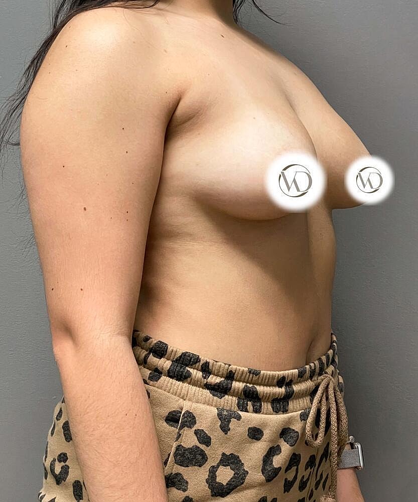 Breast Augmentation Before & After