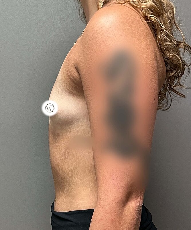 Breast Augmentation Before & After