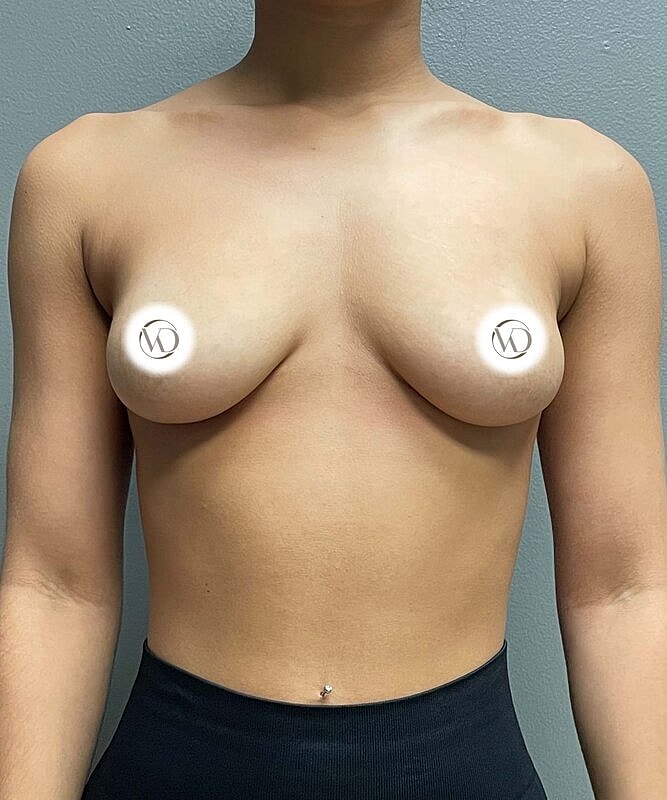 Breast Augmentation Before & After