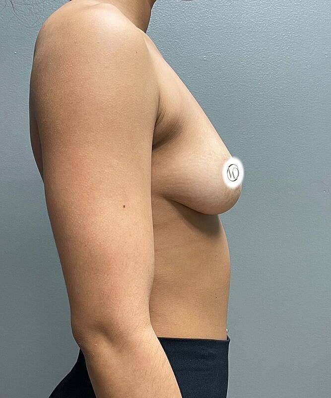 Breast Augmentation Before & After