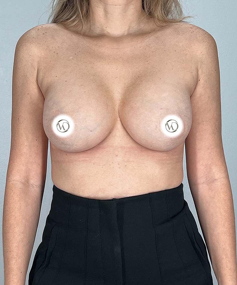 Breast Augmentation Before & After