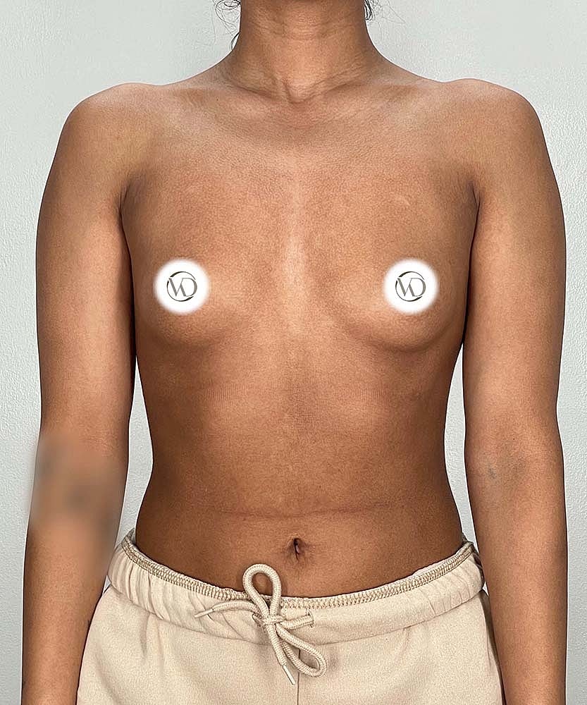 Breast Augmentation Before & After