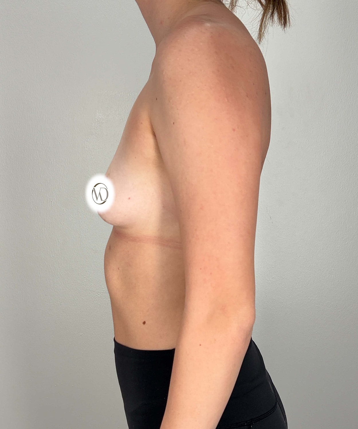 Breast Augmentation Gallery Before & After