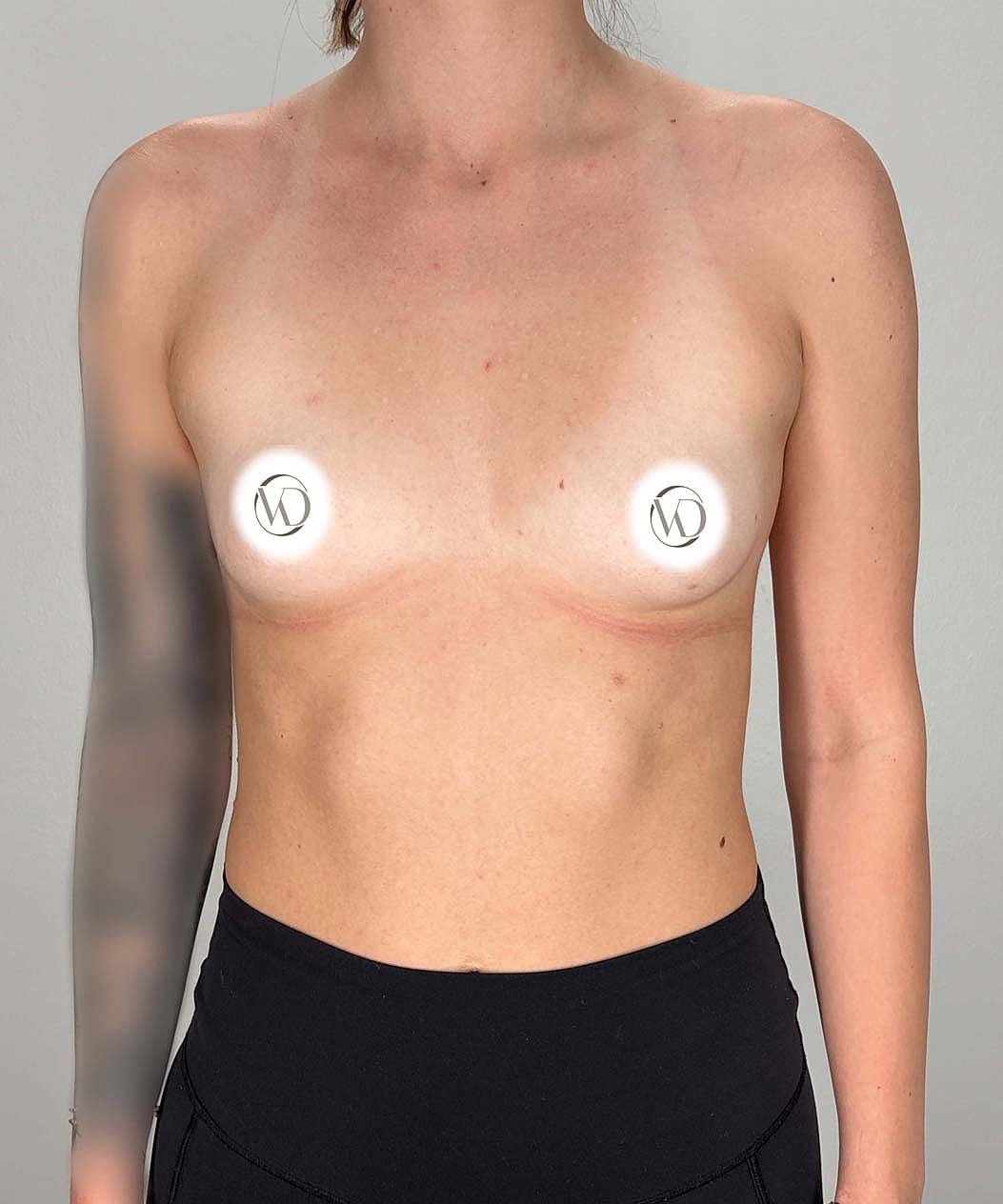 Breast Augmentation Gallery Before & After