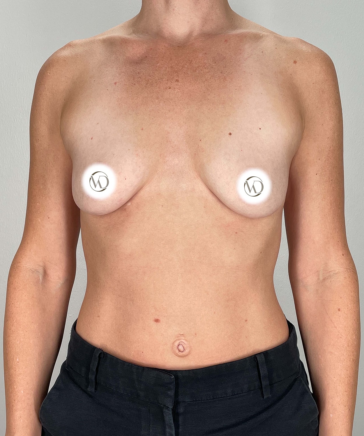 Breast Augmentation Gallery Before & After