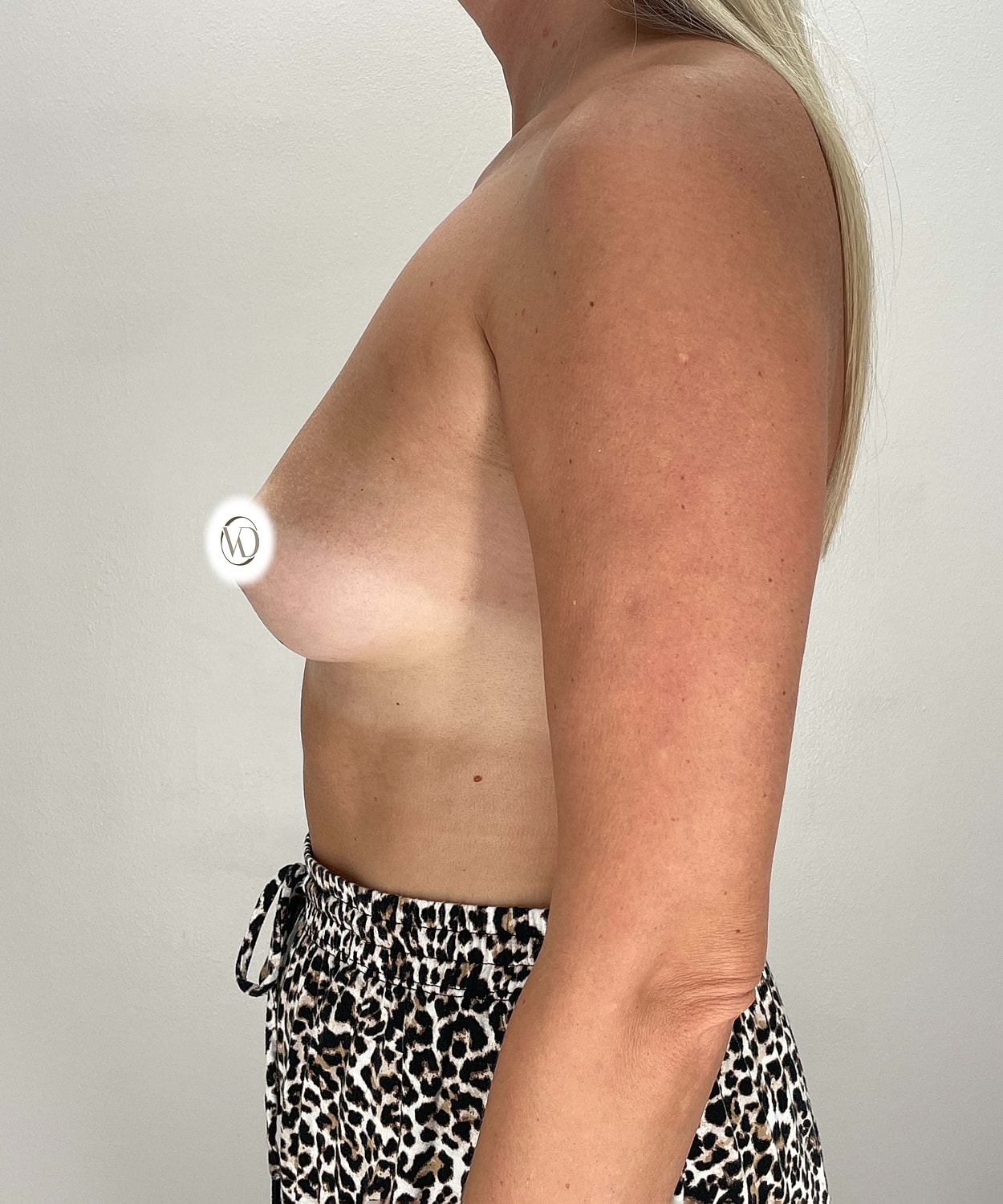 Breast Augmentation Gallery Before & After