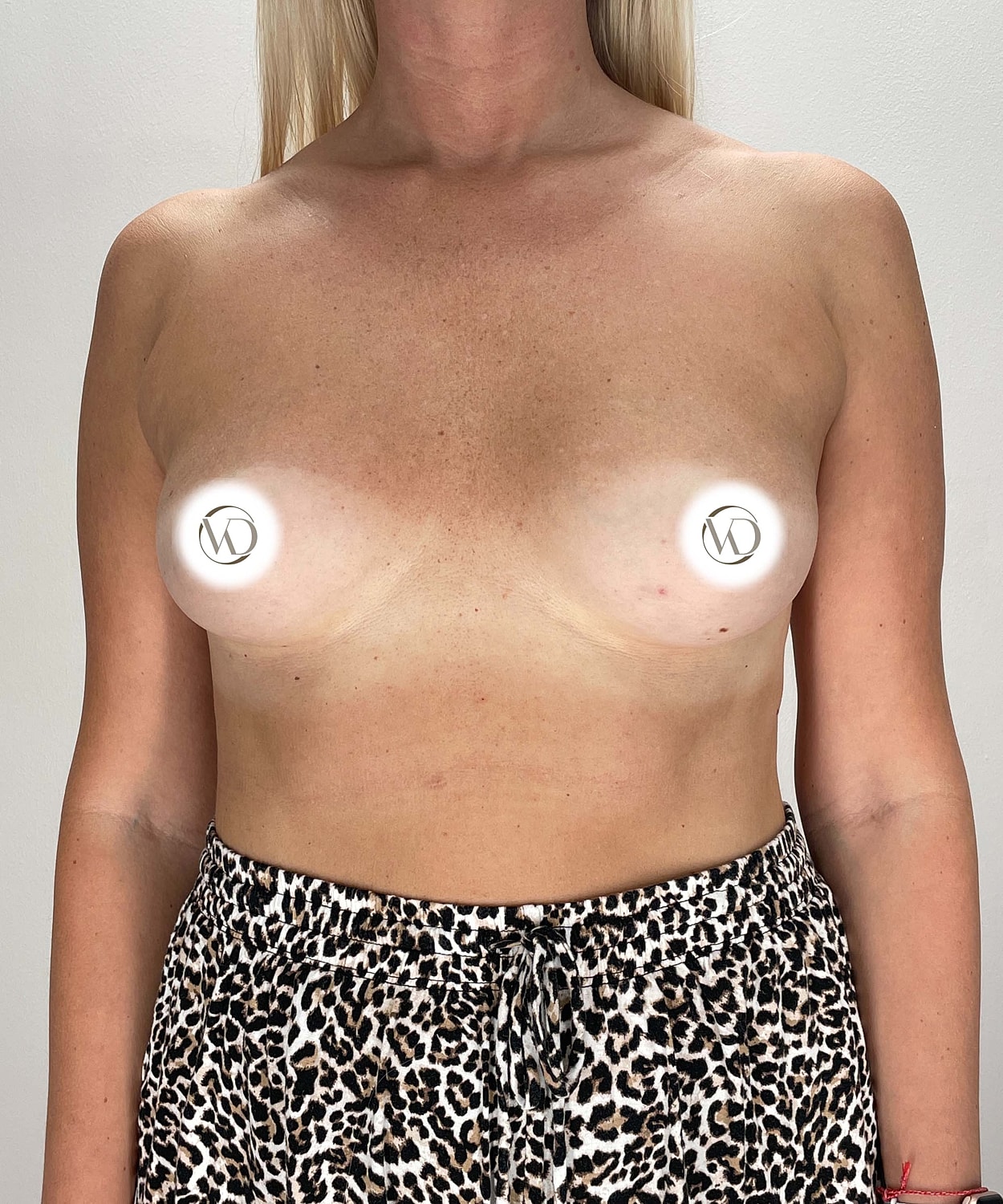 Breast Augmentation Gallery Before & After