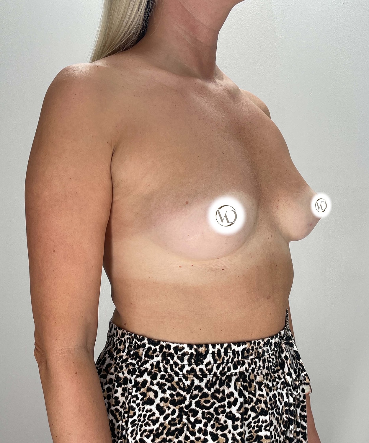 Breast Augmentation Gallery Before & After