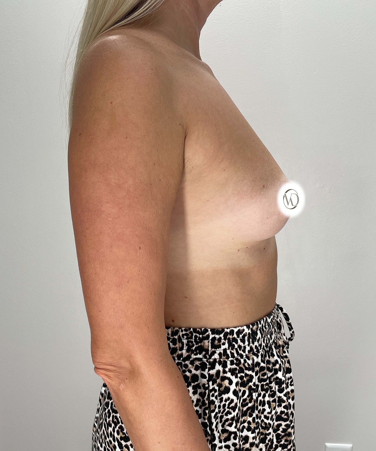 Breast Augmentation Gallery Before & After