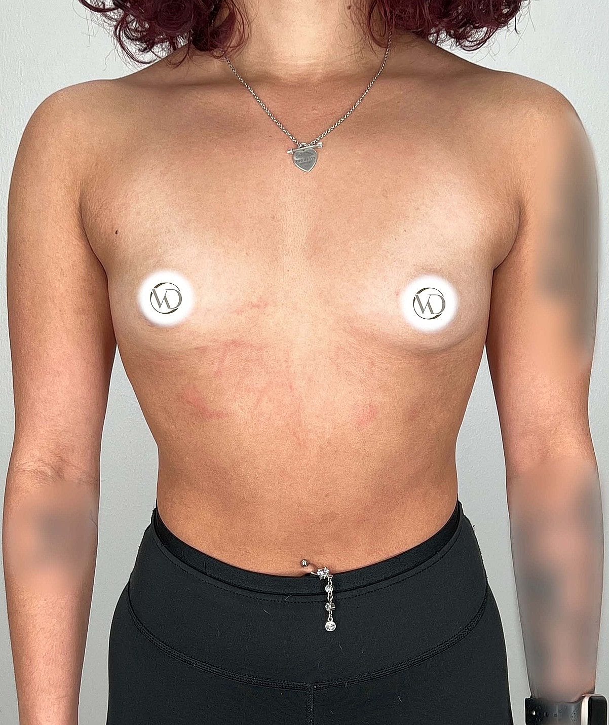 Breast Augmentation Gallery Before & After
