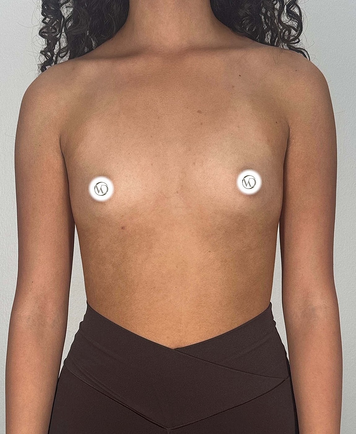 Breast Augmentation Gallery Before & After