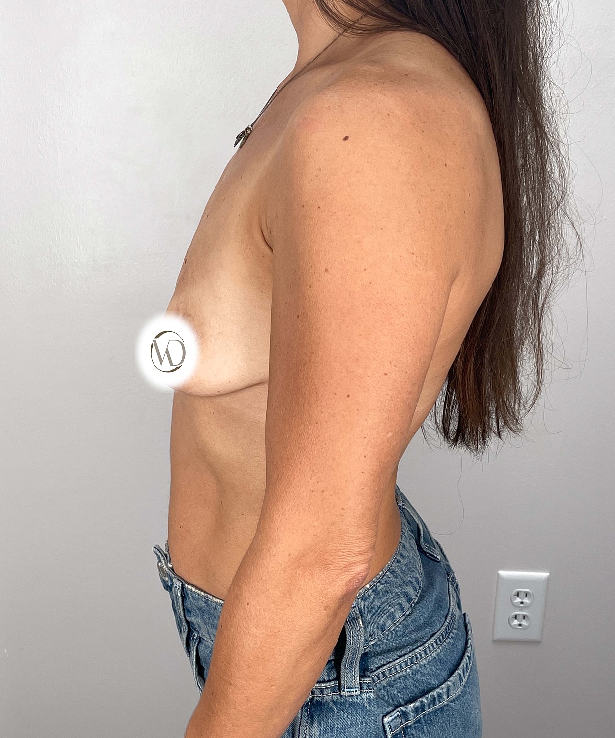 Breast Augmentation Gallery Before & After