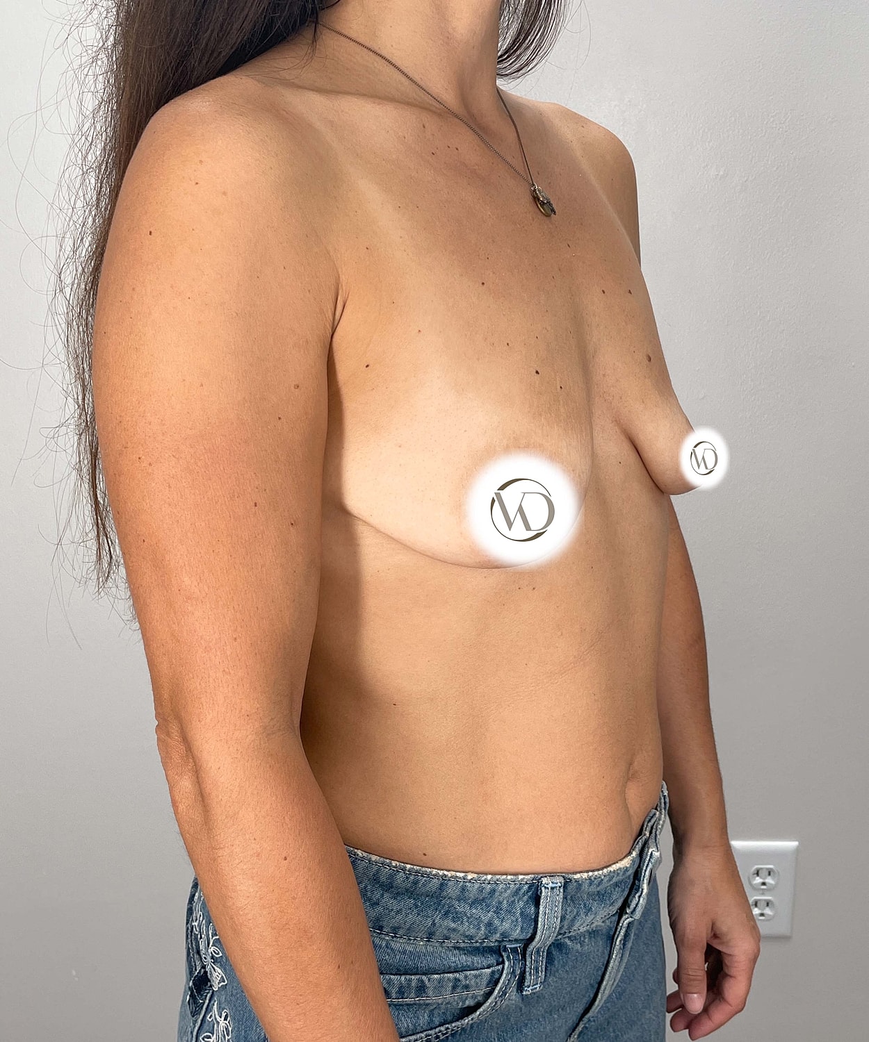Breast Augmentation Gallery Before & After