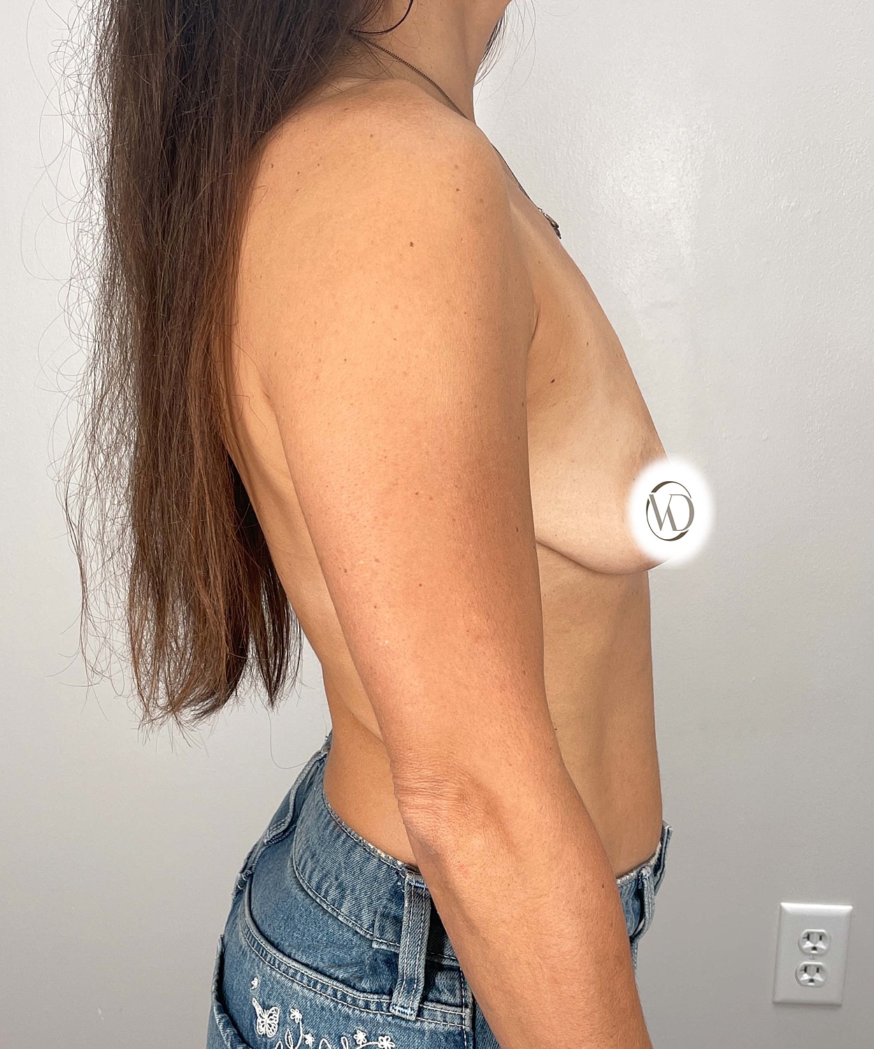 Breast Augmentation Gallery Before & After