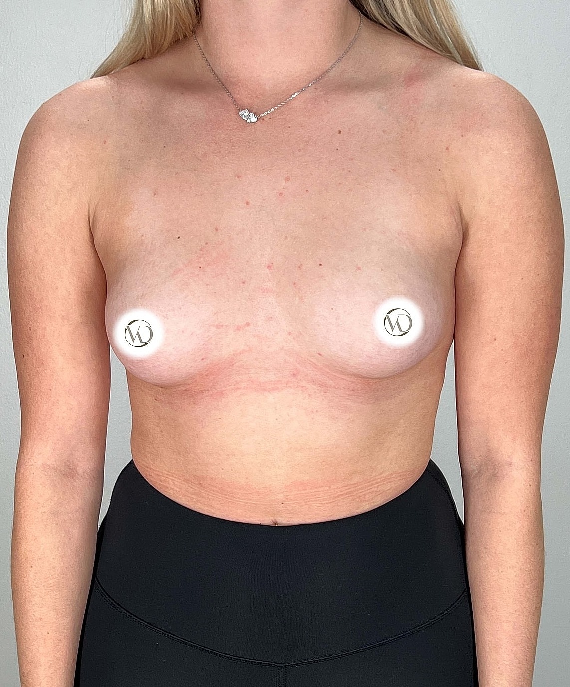 Breast Augmentation Gallery Before & After