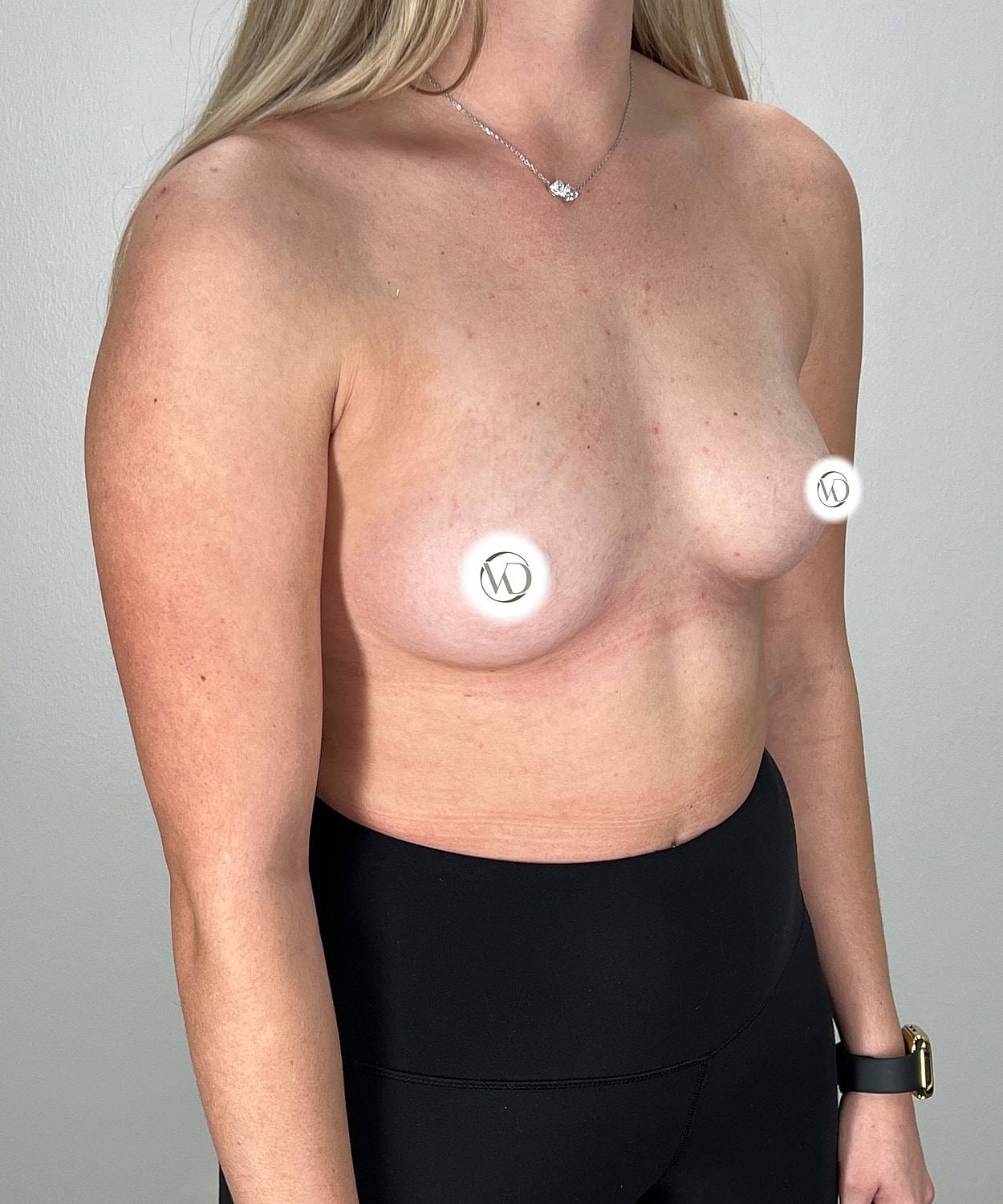 Breast Augmentation Gallery Before & After