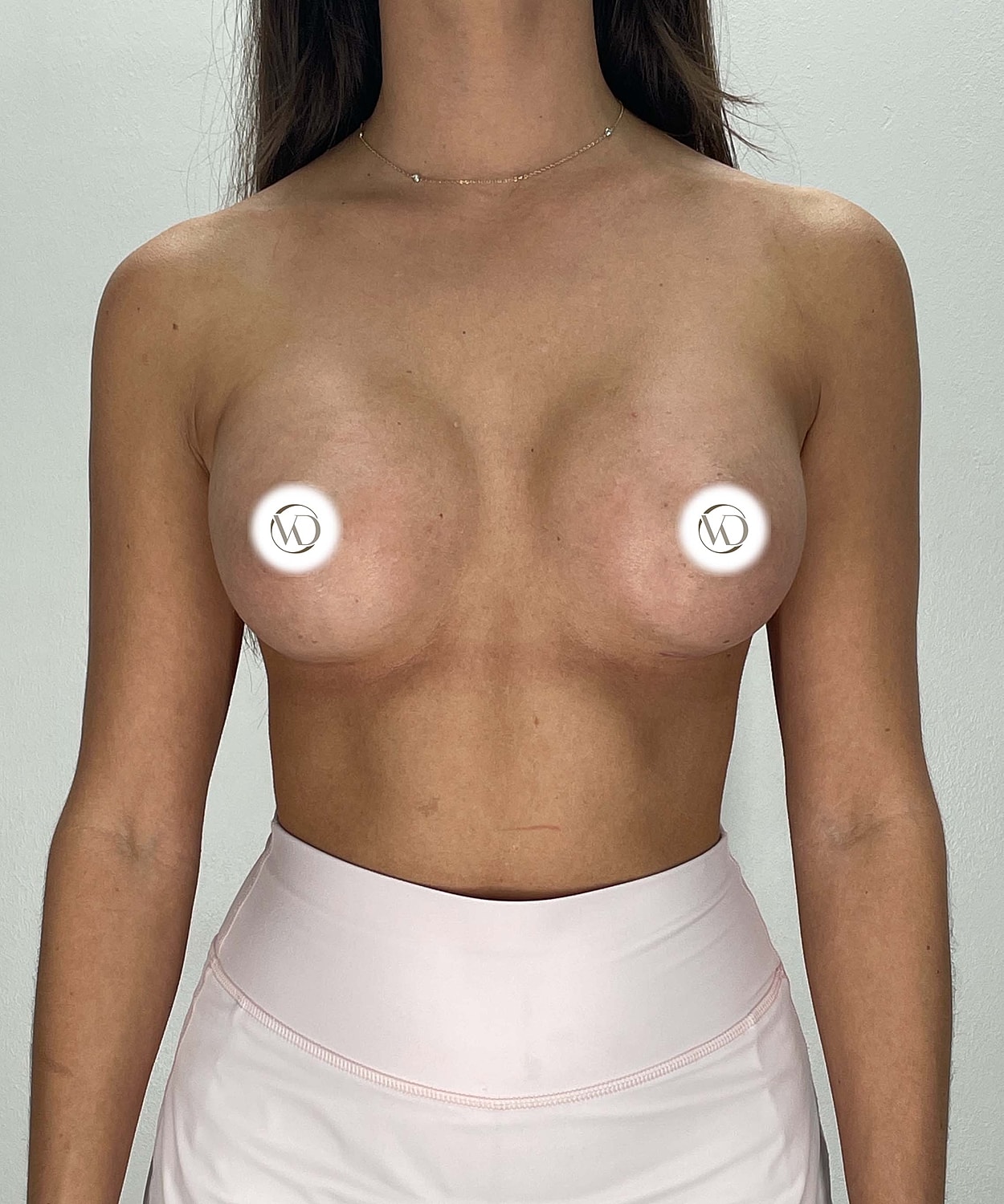 Breast Augmentation Gallery Before & After