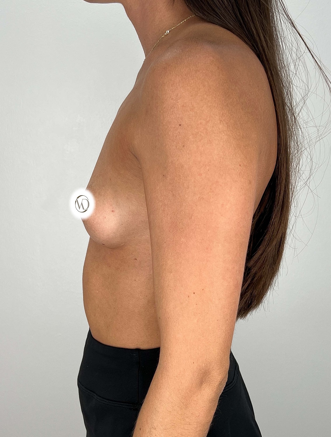 Breast Augmentation Gallery Before & After