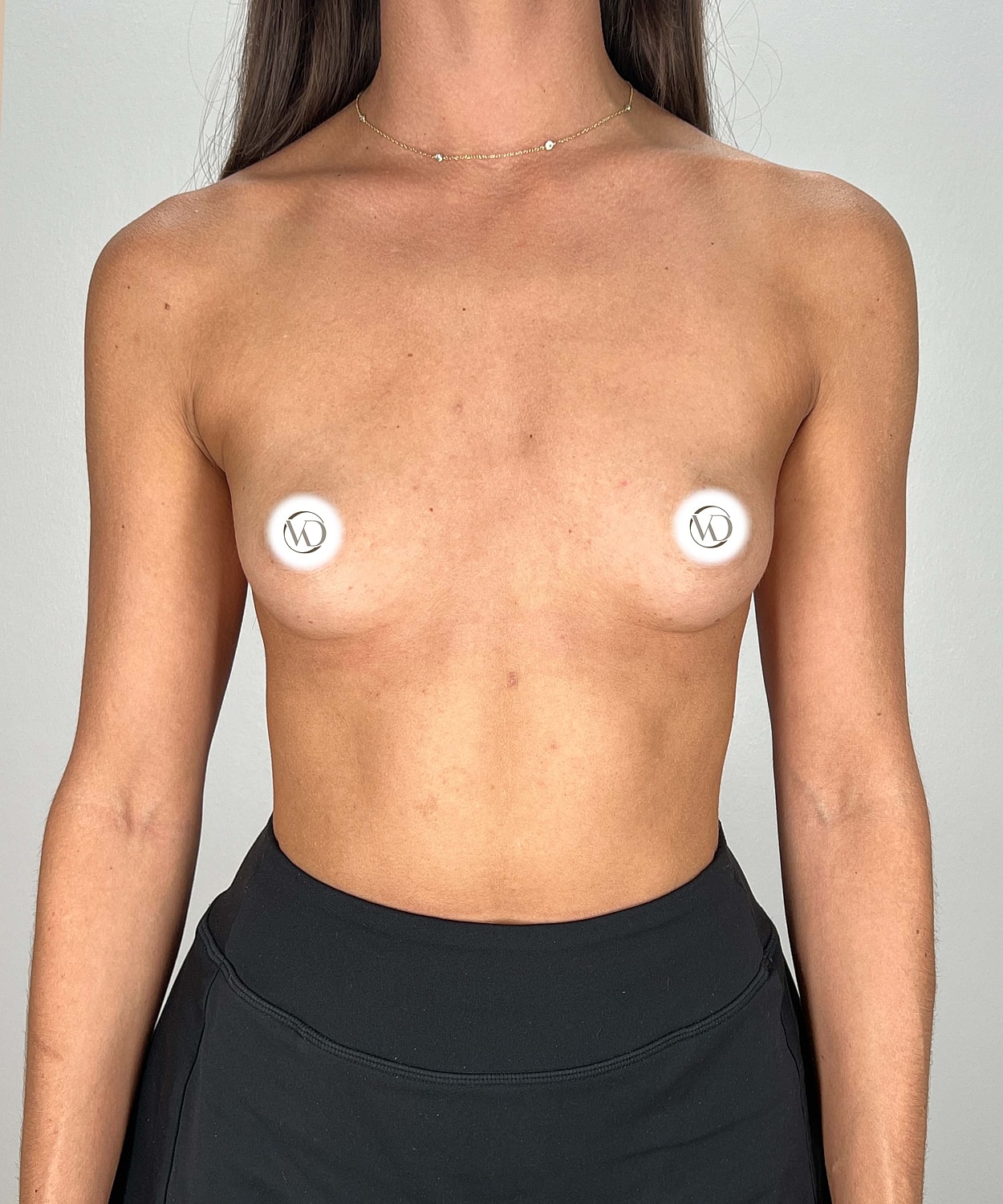 Breast Augmentation Gallery Before & After
