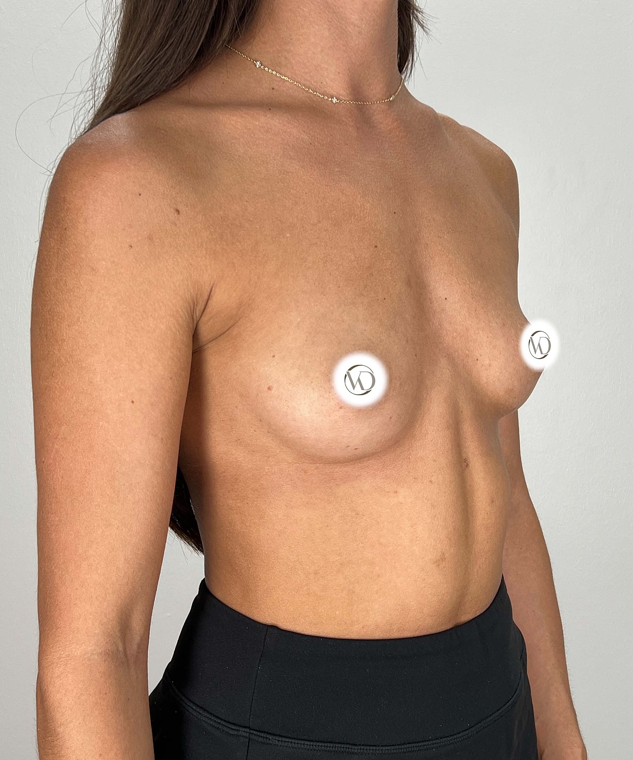 Breast Augmentation Gallery Before & After