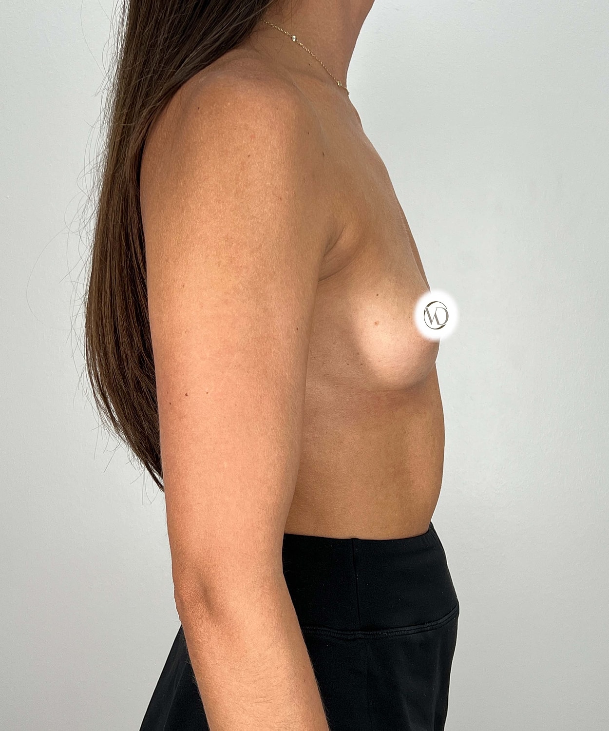 Breast Augmentation Gallery Before & After