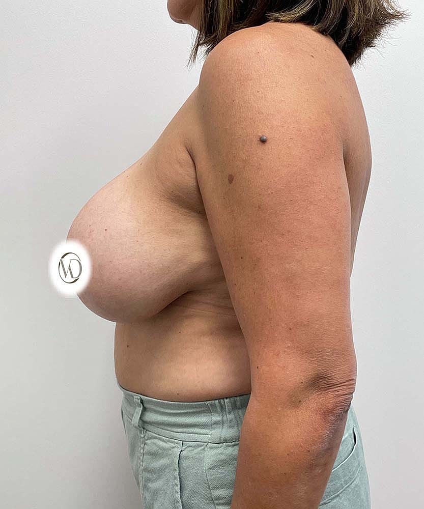 Breast Lift With Implant Removal Before & After