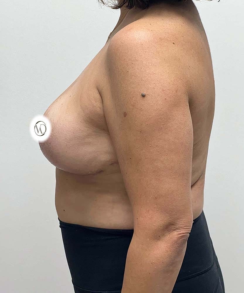Breast Lift With Implant Removal Before & After