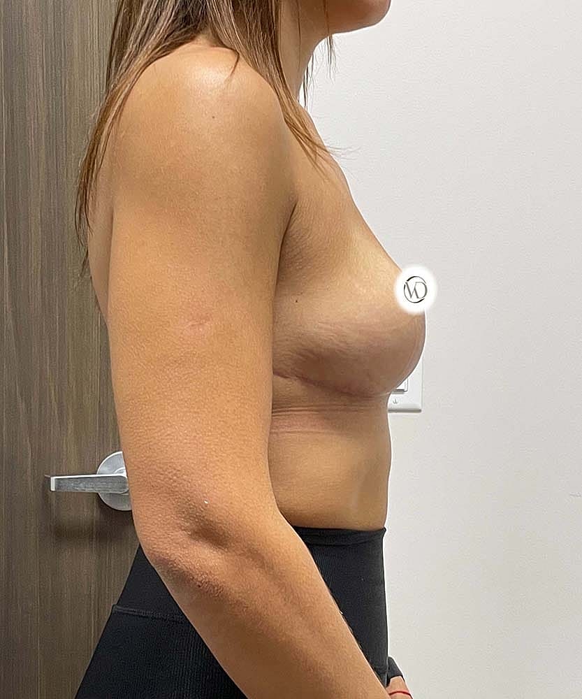 Breast Lift With Implant Removal Before & After