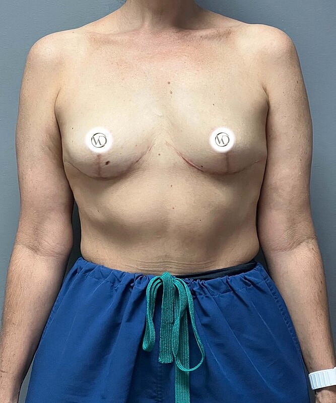 Breast Lift With Implant Removal Before & After