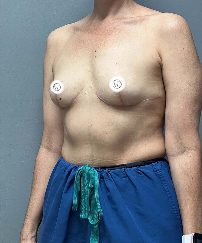 Breast Lift With Implant Removal Before & After