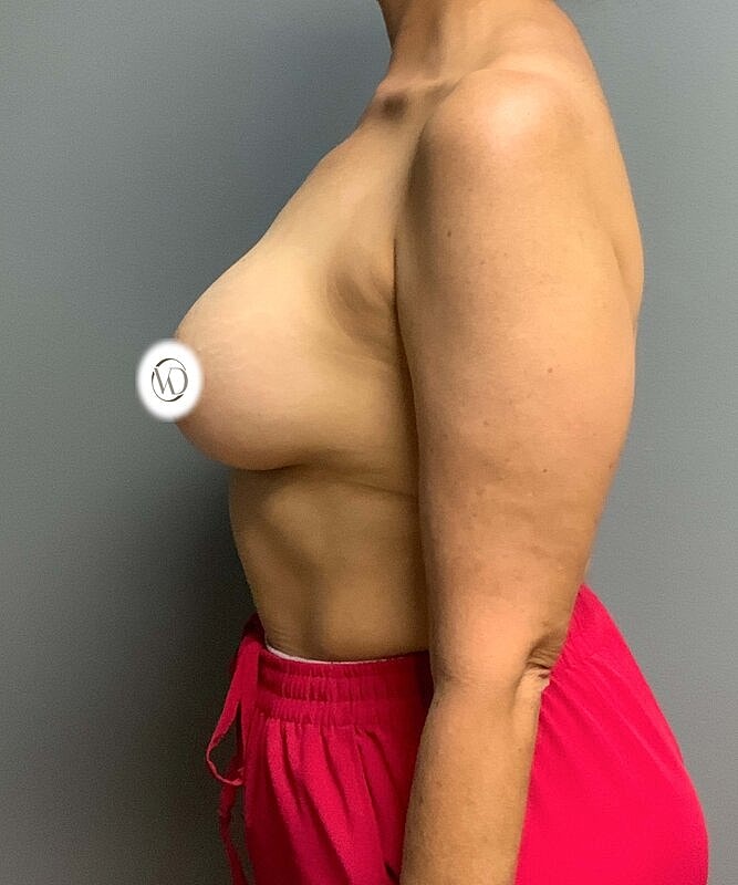 Breast Lift With Implant Removal Before & After