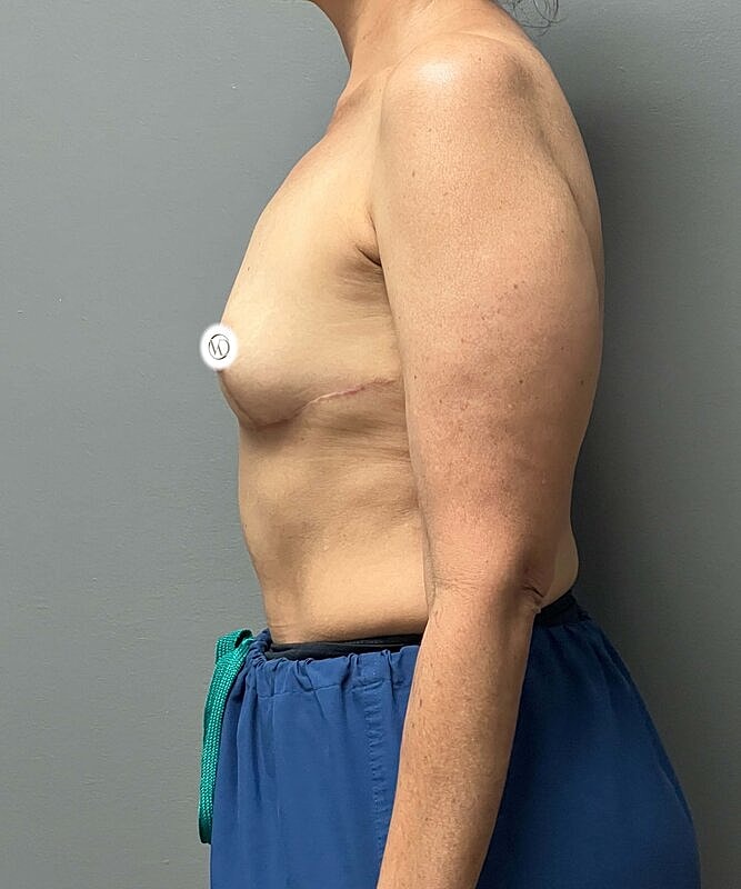 Breast Lift With Implant Removal Before & After