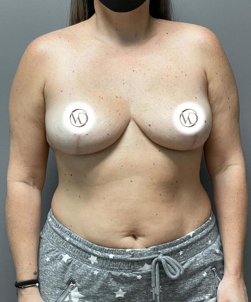 Breast Lift With Implant Removal Before & After