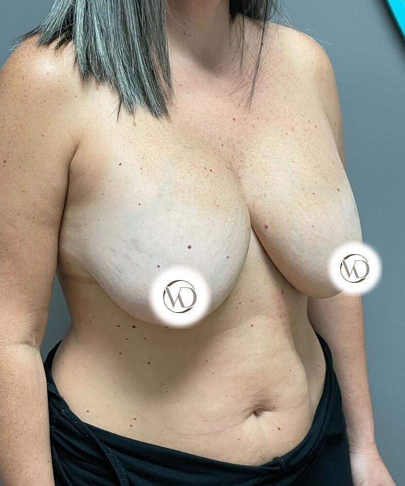 Breast Lift With Implant Removal Before & After