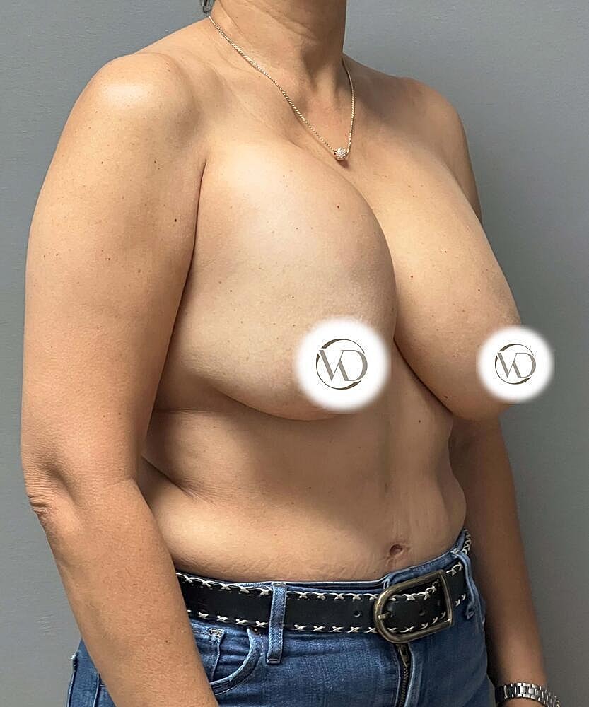 Breast Lift With Implant Removal Before & After