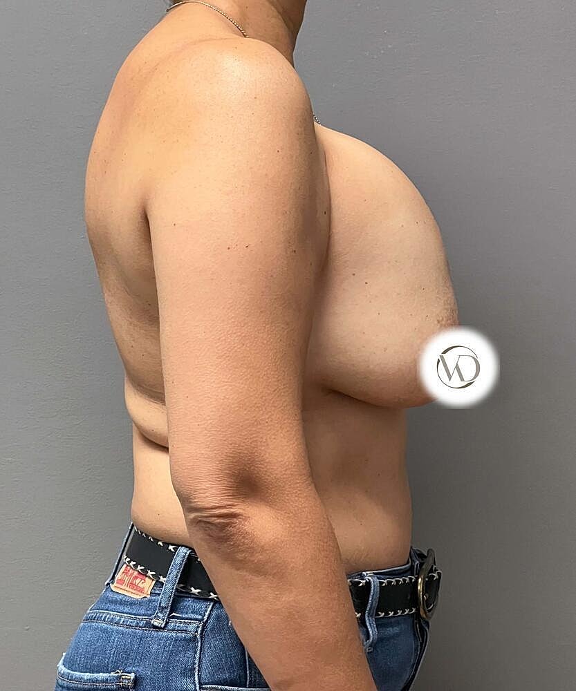 Breast Lift With Implant Removal Before & After