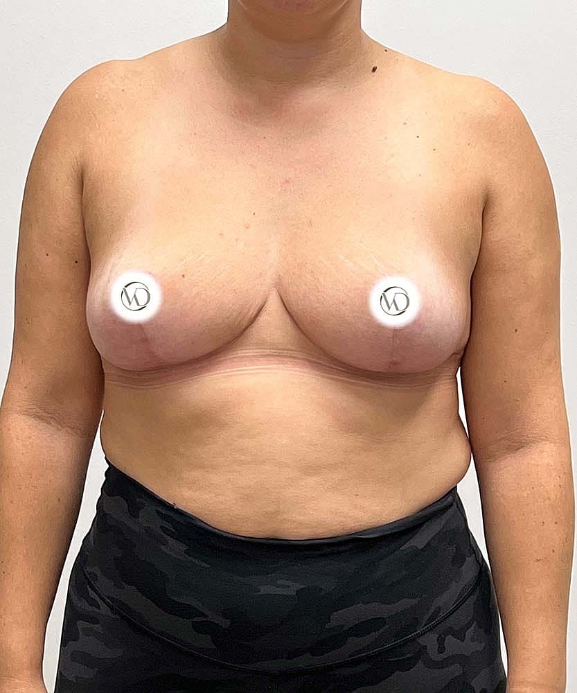 Breast Lift With Implant Removal Before & After