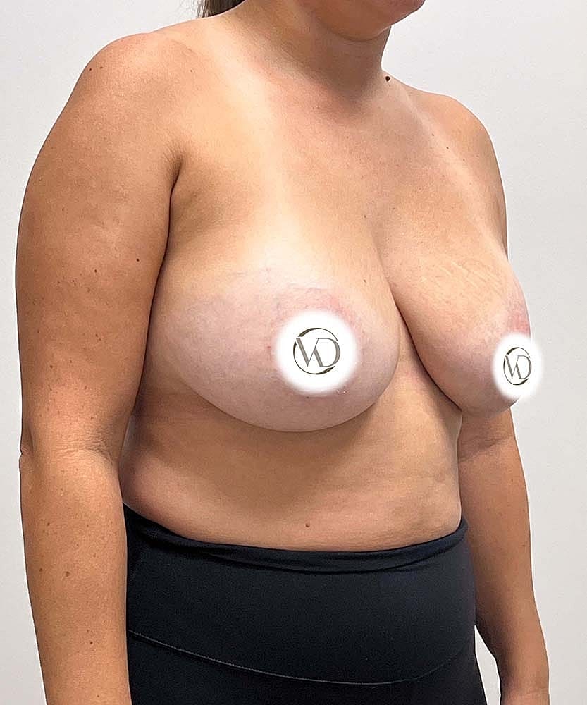 Breast Lift With Implant Removal Before & After