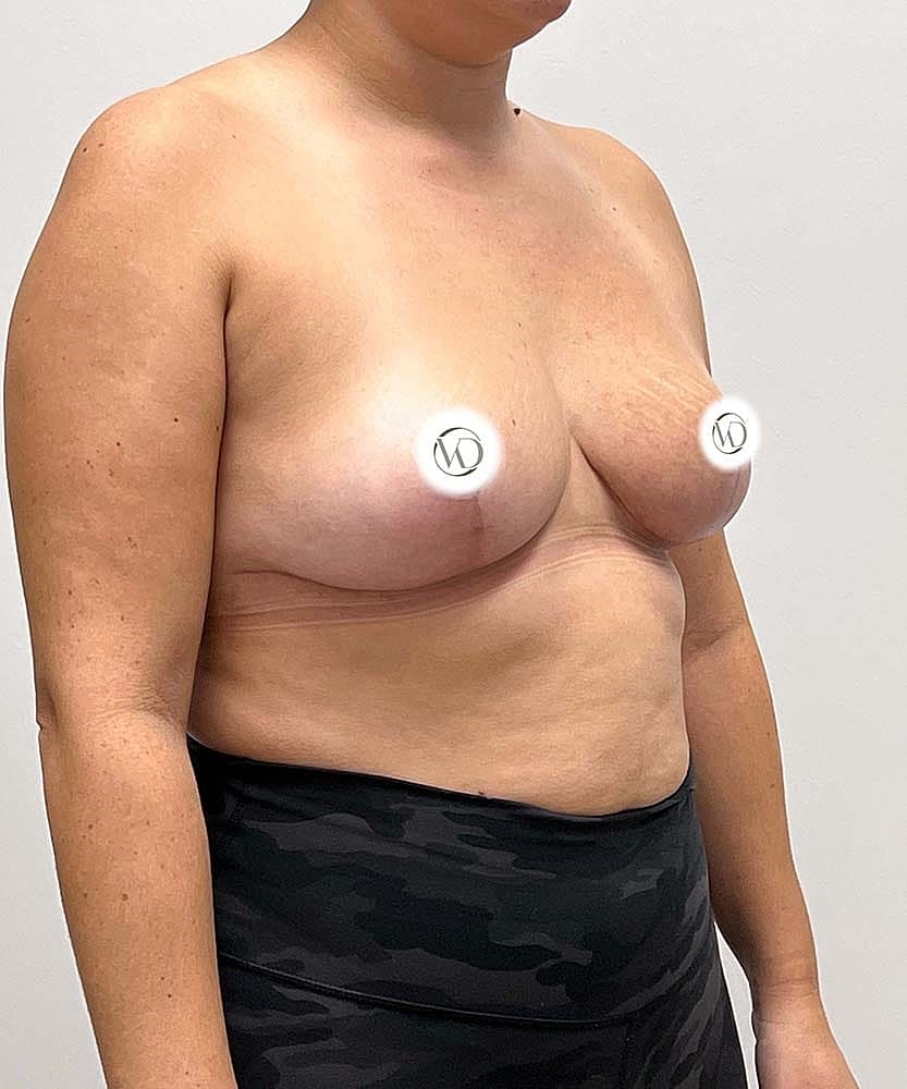 Breast Lift With Implant Removal Before & After