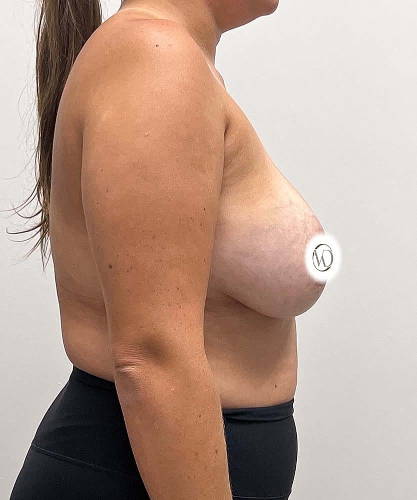 Breast Lift With Implant Removal Before & After