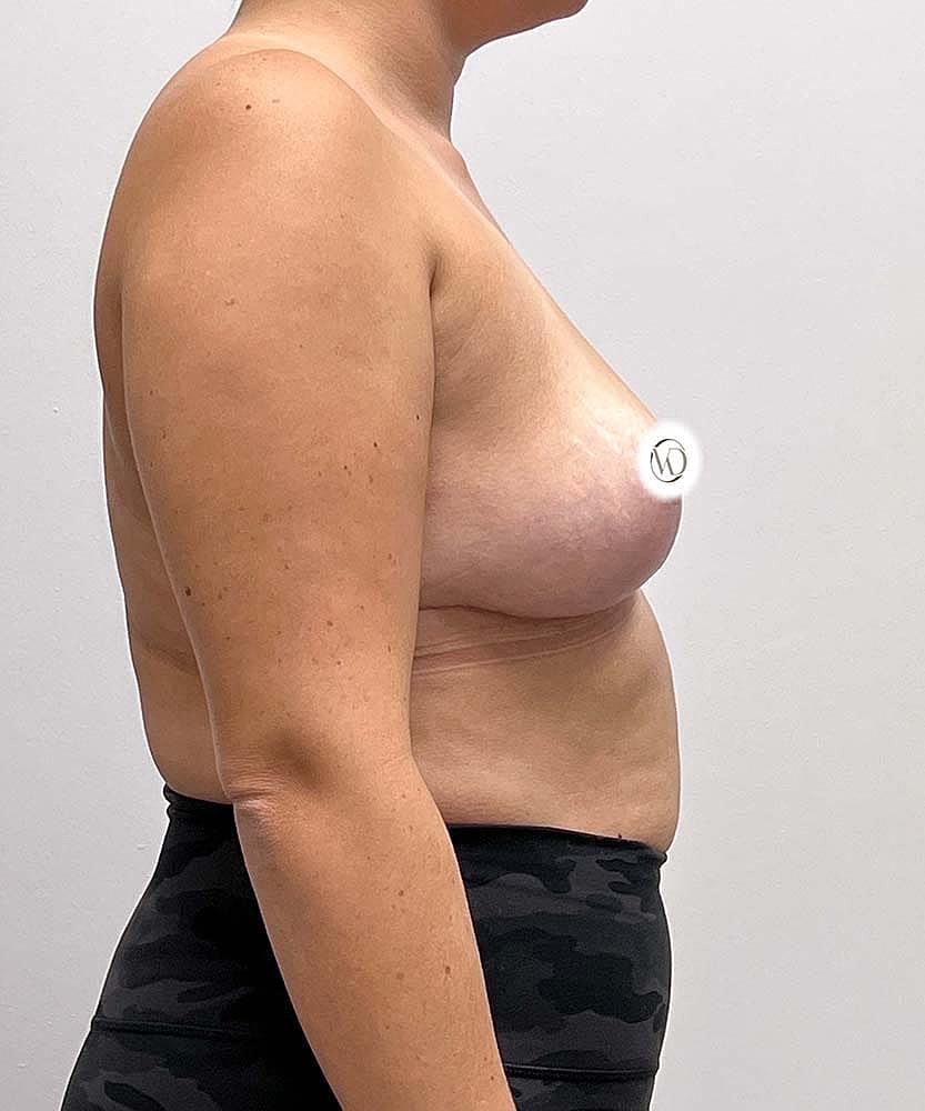 Breast Lift With Implant Removal Before & After