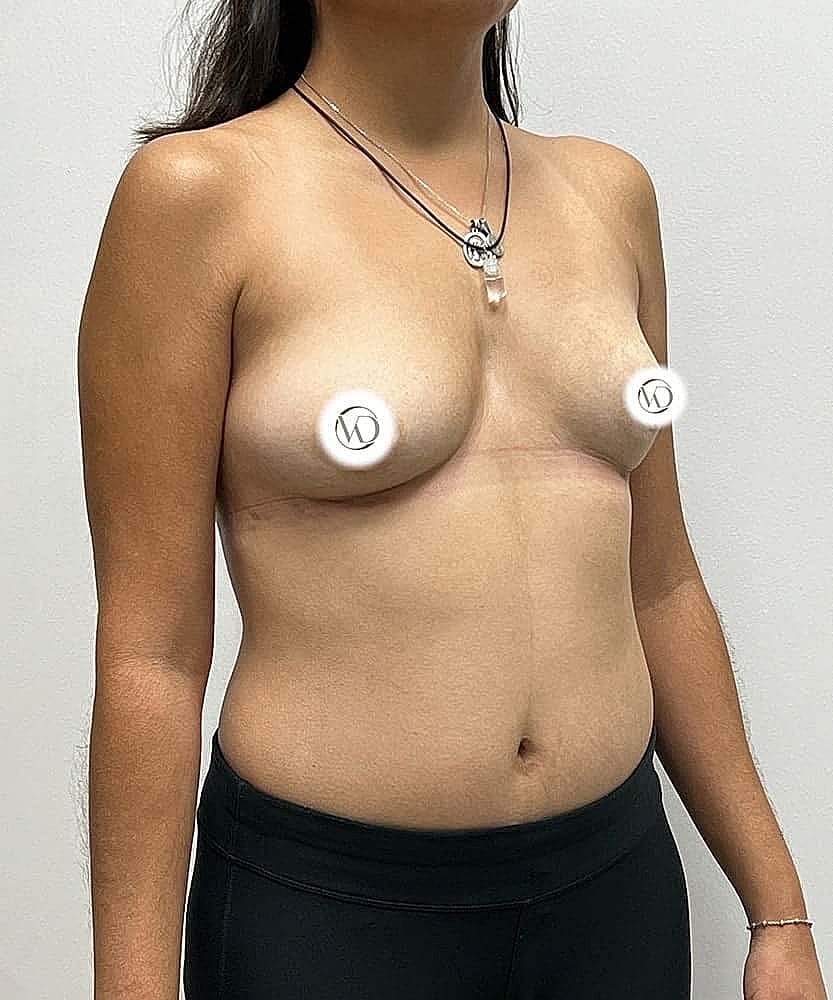 Breast Implant Removal (Explant) Gallery Before & After